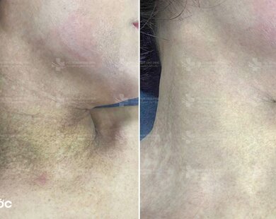 Phương pháp điều trị thâm sạm: Góc nhìn chuyên sâu từ PGS.TS Phạm Công Chính