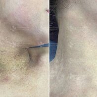 Phương pháp điều trị thâm sạm: Góc nhìn chuyên sâu từ PGS.TS Phạm Công Chính