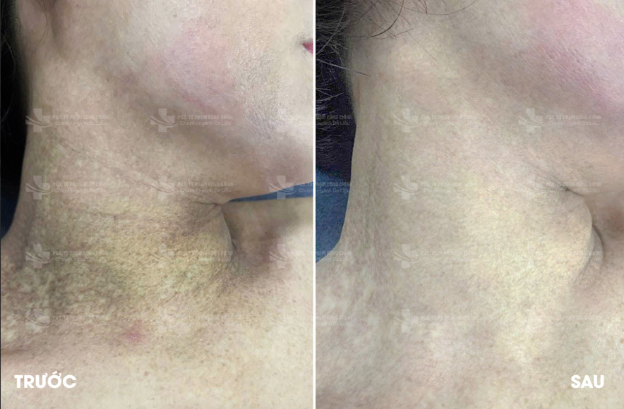 Phương pháp điều trị thâm sạm: Góc nhìn chuyên sâu từ PGS.TS Phạm Công Chính